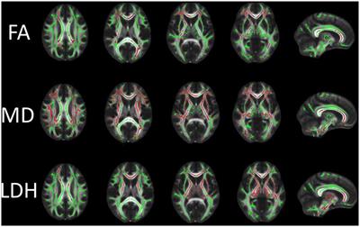 Diffusion Tensor Imaging With Tract-Based Spatial Statistics Reveals White Matter Abnormalities in Patients With Vascular Cognitive Impairment